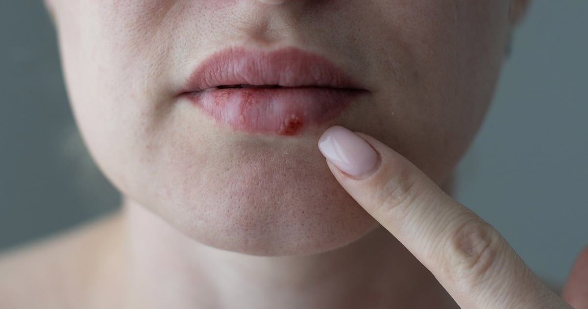 Pritelivir: la pastilla que cambia la pelea contra el herpes resistente en pacientes con defensas bajas