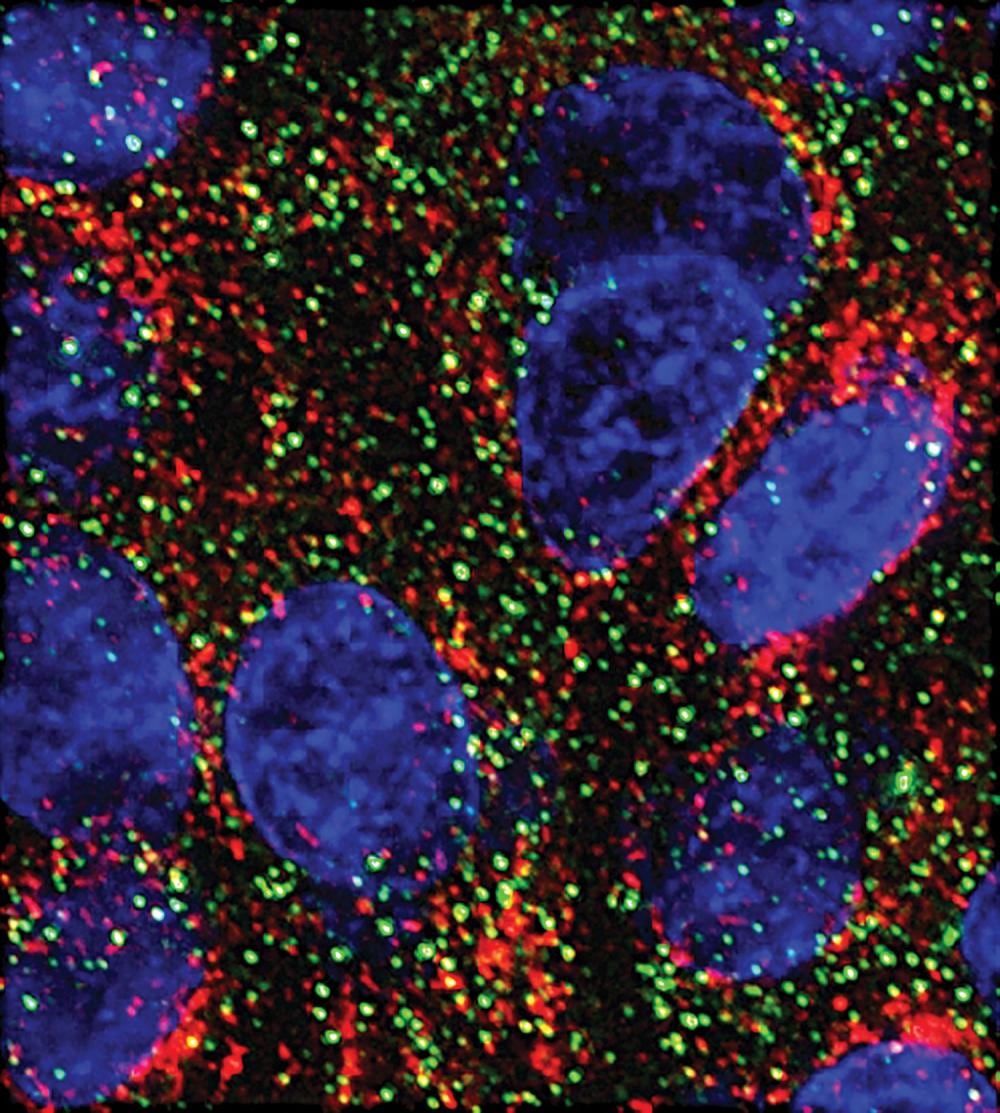 Dos microARN frenan en laboratorio el crecimiento del cáncer de páncreas